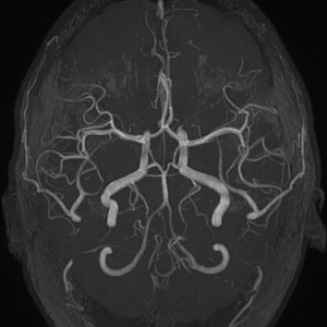 Артерии головного мозга