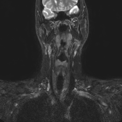 Мягкие ткани шеи