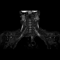 Плечевое сплетение