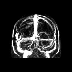 Вены головы