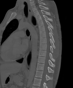Грудной отдел позвоночника