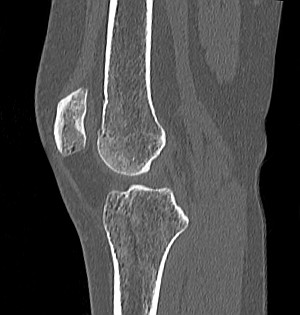 Коленный сустав