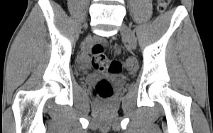 Мужской малый таз