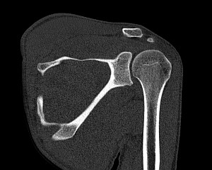 Плечевой сустав