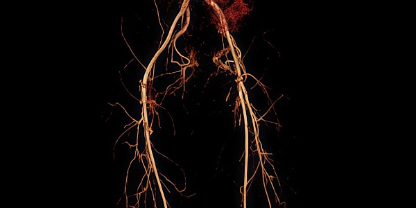 Сосуды нижних конечностей