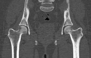 Тазобедренные суставы